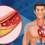 Bad Cholesterol: రక్తనాళాల్లో ఉన్న చెడు కొలెస్ట్రాల్ కరిగిపోవాలా? ఈ పండు రోజుకొకటి తినండి