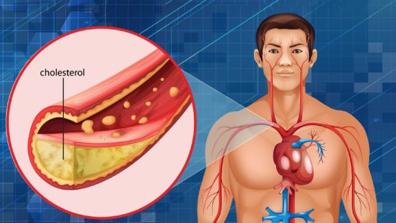 Bad Cholesterol: రక్తనాళాల్లో ఉన్న చెడు కొలెస్ట్రాల్ కరిగిపోవాలా? ఈ పండు రోజుకొకటి తినండి
