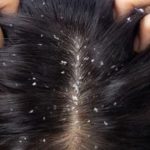 Dandruff: ఈ టిప్స్ పాటిస్తే.. చుండ్రు సమస్యే ఉండదు తెలుసా ?