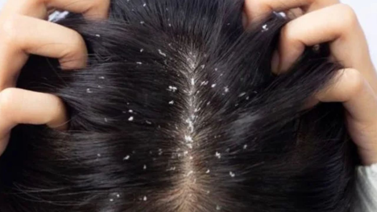 Dandruff: ఈ టిప్స్ పాటిస్తే.. చుండ్రు సమస్యే ఉండదు తెలుసా ?