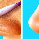 Blackheads: ముఖంపై నల్ల మచ్చలా ? ఇవి వాడితే.. ప్రాబ్లమ్ సాల్వ్