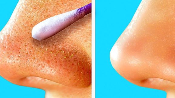 Blackheads: ముఖంపై నల్ల మచ్చలా ? ఇవి వాడితే.. ప్రాబ్లమ్ సాల్వ్