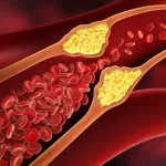 Cholesterol: ఇలా చేస్తే.. కొలెస్ట్రాల్ సమస్య దూరం !