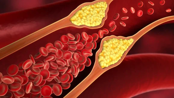 Cholesterol: ఇలా చేస్తే.. కొలెస్ట్రాల్ సమస్య దూరం !
