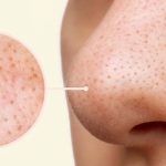 Blackheads: ముఖంపై మచ్చలు పోవాలంటే ? ఈ సింపుల్ టిప్స్ ఫాలో అవ్వండి
