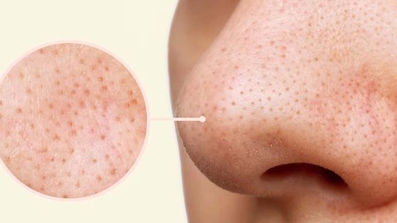 Blackheads: ముఖంపై మచ్చలు పోవాలంటే ? ఈ సింపుల్ టిప్స్ ఫాలో అవ్వండి