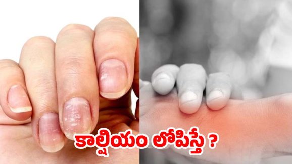 Calcium Deficiency: మీలో ఈ లక్షణాలున్నాయా ? అస్సలు లైట్ తీసుకోవద్దు !