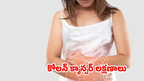 Colon Cancer: మహిళలూ.. ఈ లక్షణాలను అస్సలు నిర్లక్ష్యం చేయొద్దు !