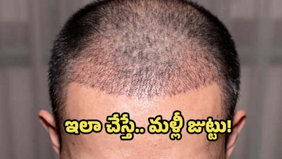 Hair Regrowth: సర్జరీ, మందులు లేకుండానే హెయిర్ గ్రోత్.. గుడ్ న్యూస్ చెప్పిన శాస్త్రవేత్తలు