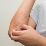 Allergy In Monsoon: వర్షాకాలంలో అలెర్జీ సమస్యలు రాకూడదంటే ?