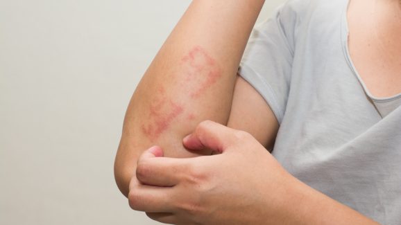 Allergy In Monsoon: వర్షాకాలంలో అలెర్జీ సమస్యలు రాకూడదంటే ?