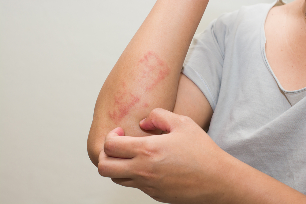 Allergy In Monsoon: వర్షాకాలంలో అలెర్జీ సమస్యలు రాకూడదంటే ?