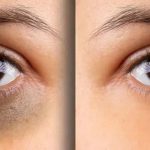 Dark Circles: డార్క్ సర్కిల్స్‌తో ఇబ్బంది పడుతున్నారా ? ఈ టిప్స్ పాటిస్తే.. ప్రాబ్లమ్ సాల్వ్ !