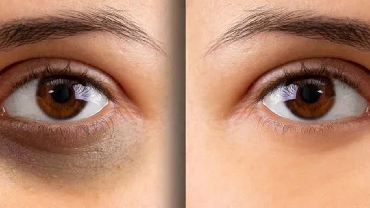 Dark Circles: డార్క్ సర్కిల్స్‌తో ఇబ్బంది పడుతున్నారా ? ఈ టిప్స్ పాటిస్తే.. ప్రాబ్లమ్ సాల్వ్ !
