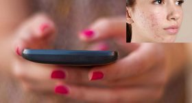 Skin Problems: మొబైల్ ఫోన్లతో చర్మ సమస్యలు.. పరిశోధనల్లో షాకింగ్ నిజాలు