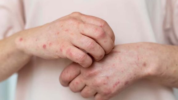 Causes Of Skin Allergy: స్కిన్ అలెర్జీకి కారణాలేంటో తెలుసా ?