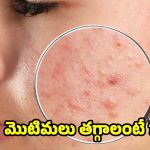 Acne Free Skin: ఈ టిప్స్ పాటిస్తే.. ముఖంపై ఒక్క మొటిమ కూడా ఉండదు తెలుసా ?