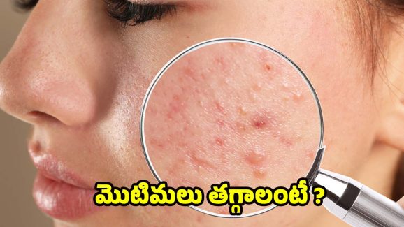 Acne Free Skin: ఈ టిప్స్ పాటిస్తే.. ముఖంపై ఒక్క మొటిమ కూడా ఉండదు తెలుసా ?
