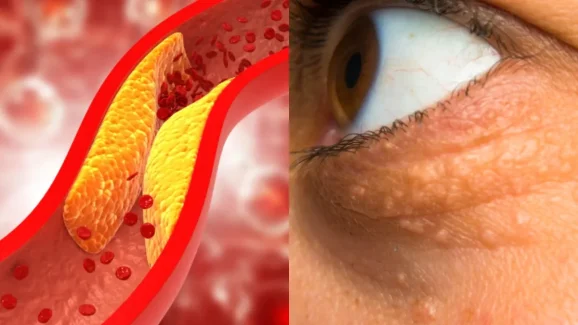 Cholesterol: కొలెస్ట్రాల్ పెరిగితే.. శరీరంలో ఎలాంటి లక్షణాలు కనిపిస్తాయ్ !