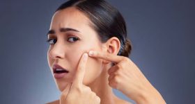 Pimple Free Skin: ఈ టిప్స్ పాటిస్తే.. మొటిమలు మాయం