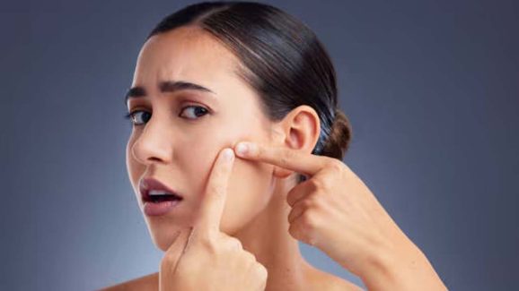 Pimple Free Skin: ఈ టిప్స్ పాటిస్తే.. మొటిమలు మాయం