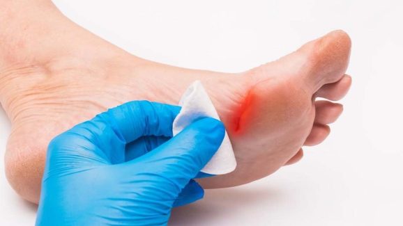 Diabetic Patient: డయాబెటిస్ ఉన్న వారిలో.. గాయాలు త్వరగా ఎందుకు మానవు ?