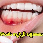 Oral Cancer: గొంతు క్యాన్సర్ లక్షణాలు ఎలా ఉంటాయి ?
