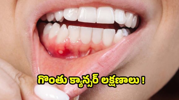 Oral Cancer: గొంతు క్యాన్సర్ లక్షణాలు ఎలా ఉంటాయి ?