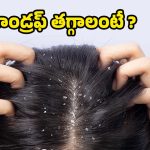 Dandruff : శాశ్వతంగా చుండ్రుకు చెక్ పెట్టే టిప్స్ ఇవే !