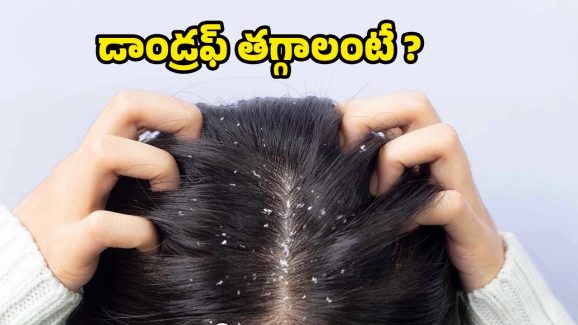 Dandruff : శాశ్వతంగా చుండ్రుకు చెక్ పెట్టే టిప్స్ ఇవే !