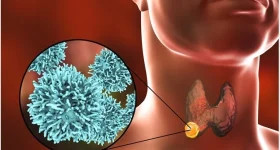Thyroid Cancer: మీలో ఈ లక్షణాలు ఉన్నాయా ? థైరాయిడ్ క్యాన్సర్ కావొచ్చు !