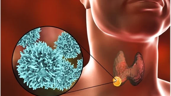 Thyroid Cancer: మీలో ఈ లక్షణాలు ఉన్నాయా ? థైరాయిడ్ క్యాన్సర్ కావొచ్చు !