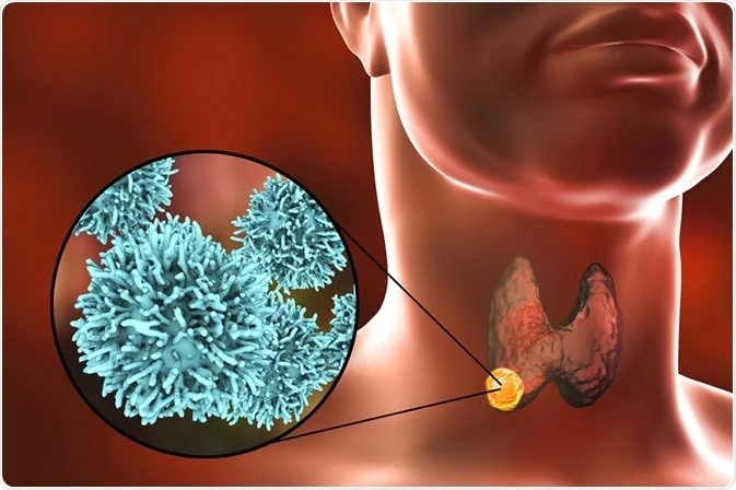 Thyroid Cancer: మీలో ఈ లక్షణాలు ఉన్నాయా ? థైరాయిడ్ క్యాన్సర్ కావొచ్చు !