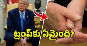 Donald Trump Health: ఆ వ్యాధితో బాధపడుతున్న ట్రంప్.. వైట్‌హౌజ్ కీలక ప్రకటన