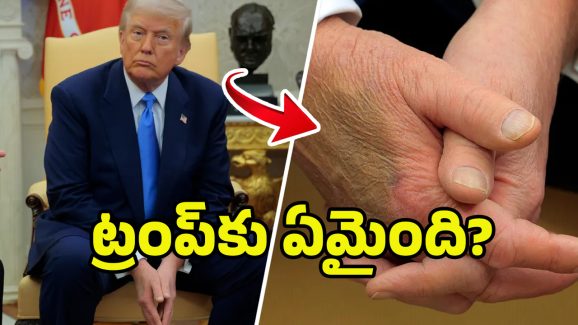 Donald Trump Health: ఆ వ్యాధితో బాధపడుతున్న ట్రంప్.. వైట్‌హౌజ్ కీలక ప్రకటన