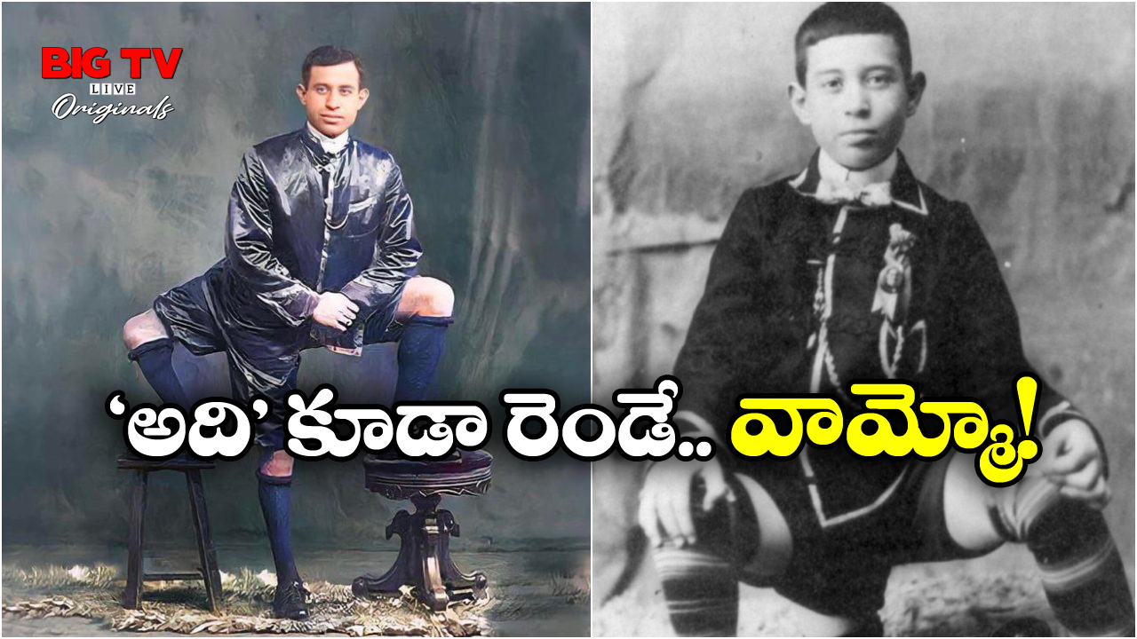 Man With 3 Legs: మూడు కాళ్ల సుందరాంగుడు.. 16 వేళ్లు.. 2 జననాంగాలు.. ఇతడిది ఓ అరుదైన జన్మ!