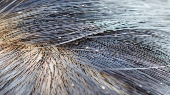 Lice Remedies: తల పేలతో నిండిపోయిందా? ఈ ఇంటి చిట్కాలు పాటించండి, పూర్తిగా పోతాయి