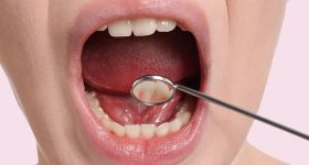Oral cancer: జాగ్రత్త! నోటి ఆరోగ్యం సరిగ్గా లేకపోవడం వల్ల కూడా క్యాన్సర్ వస్తుందట..