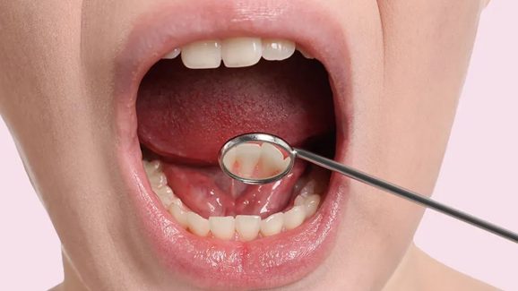 Oral cancer: జాగ్రత్త! నోటి ఆరోగ్యం సరిగ్గా లేకపోవడం వల్ల కూడా క్యాన్సర్ వస్తుందట..