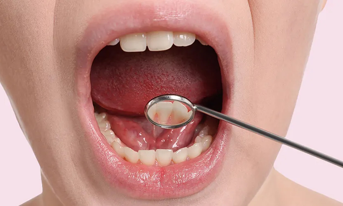 Oral cancer: జాగ్రత్త! నోటి ఆరోగ్యం సరిగ్గా లేకపోవడం వల్ల కూడా క్యాన్సర్ వస్తుందట..