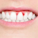 Bleeding Gums: చిగుళ్ల నుంచి రక్తం కారుతోందా? అయితే ఈ రోగాలకు సిగ్నల్ జాగ్రత్త..!