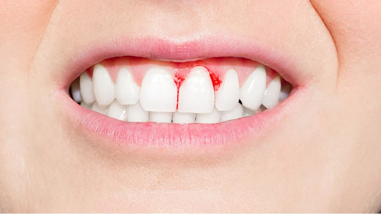 Bleeding Gums: చిగుళ్ల నుంచి రక్తం కారుతోందా? అయితే ఈ రోగాలకు సిగ్నల్ జాగ్రత్త..!