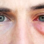 Eye Infection: వర్షాకాలంలో వెంటాడే కంటి ఇన్ఫెక్షన్లు.. ఎలా నివారించాలో తెలుసా?