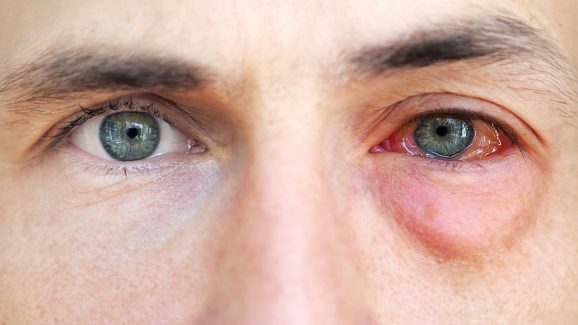 Eye Infection: వర్షాకాలంలో వెంటాడే కంటి ఇన్ఫెక్షన్లు.. ఎలా నివారించాలో తెలుసా?