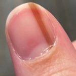Nail Scratch: గోటిపై చిన్న గీత పడితే పట్టించుకోలేదు, చివరికి అదే ఒక ప్రాణాంతక వ్యాధి లక్షణం అని తేలింది