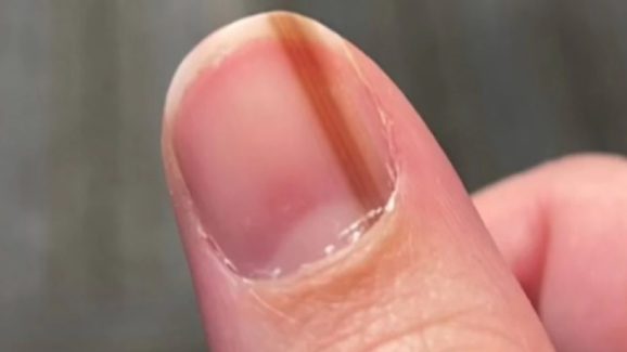 Nail Scratch: గోటిపై చిన్న గీత పడితే పట్టించుకోలేదు, చివరికి అదే ఒక ప్రాణాంతక వ్యాధి లక్షణం అని తేలింది