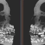Hyperdontia: ఈ అమ్మాయి నోటిలో 81 దంతాలు, ఆ చిన్ని నోటిలో అన్ని ఎలా పట్టాయో?