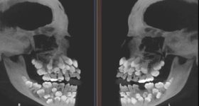 Hyperdontia: ఈ అమ్మాయి నోటిలో 81 దంతాలు, ఆ చిన్ని నోటిలో అన్ని ఎలా పట్టాయో?