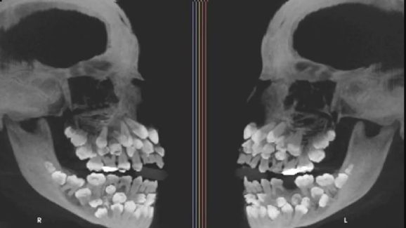 Hyperdontia: ఈ అమ్మాయి నోటిలో 81 దంతాలు, ఆ చిన్ని నోటిలో అన్ని ఎలా పట్టాయో?
