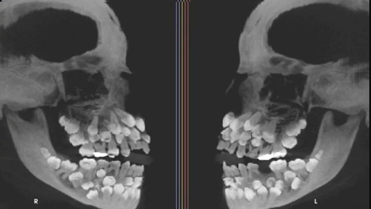 Hyperdontia: ఈ అమ్మాయి నోటిలో 81 దంతాలు, ఆ చిన్ని నోటిలో అన్ని ఎలా పట్టాయో?